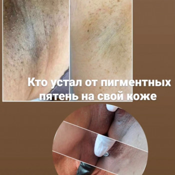 Відбілювання делікатних зон на тілі
                    Мастер депиляции Аліна Каменское