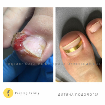  #врослийніготь #скобипластини #подологдитячий #золотапластина