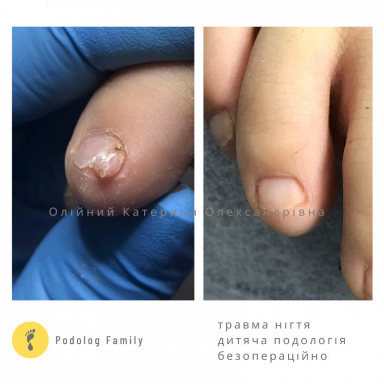  #дитячаподологія #травманігтя #лікарподолог #новоутворення #лікуваннябезоперації, фото - Подолог Катерина Олександрівна Олійник