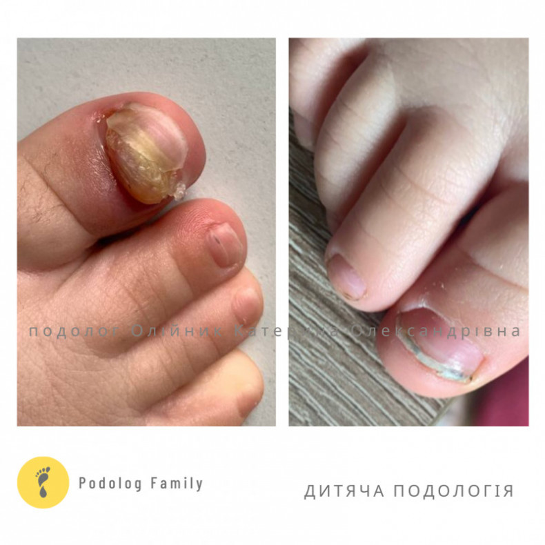  #травманігтя #дитячийподологкиїв, фото - Подолог Катерина Олександрівна Олійник
