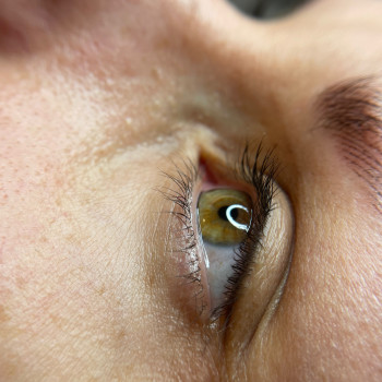 Загоєнна міжвійна стрілочка