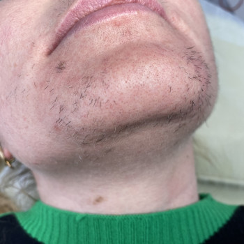 Перед процедурою електроепіляціі