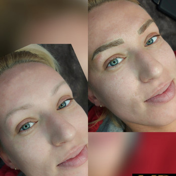 Мікроблейдинг