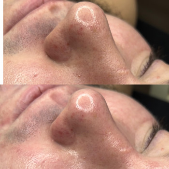 Механічна чистка обличчя+поверхневий пілинг