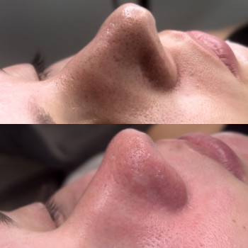 Механічна чистка обличчя+поверхневий пілинг