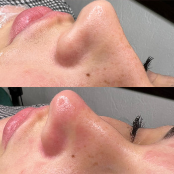 Механічна чистка обличчя+поверхневий пілинг