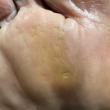 Стержнева мозоля на плюсневій ділянці стопи, фото до обробки