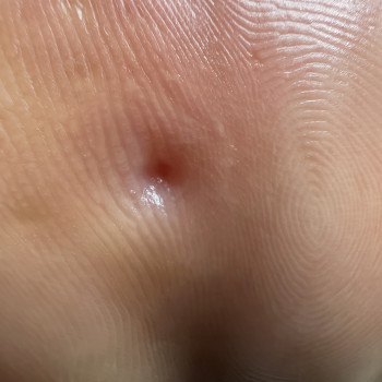 Мозоля після обробки