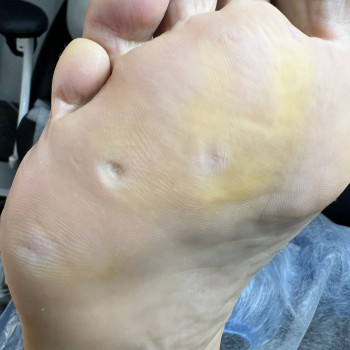 Мозолі на плюсні , фото після обробки.