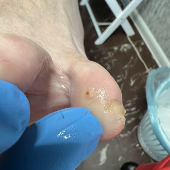 Обробка мʼяких міжпальцевих мозолів.