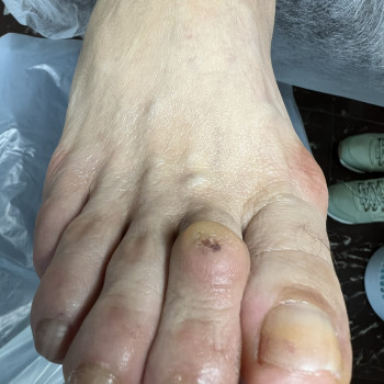 Мозоля на суглобових ділянках пальців , фото до обробки.