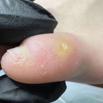 Стержнева мозоля на 5- му пальці.