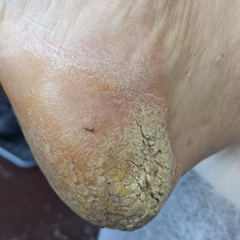 Виражений гіперкератоз. Множинні тріщини.