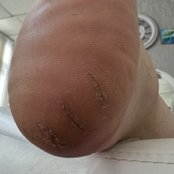 Дермальні болючі тріщини.