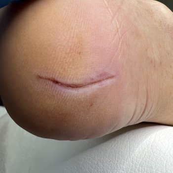 Глибока тріщина стопи. 
Фото після обробки.