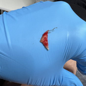 Вростаючий кут нігтя