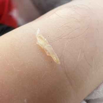 Видалений кут нігтя