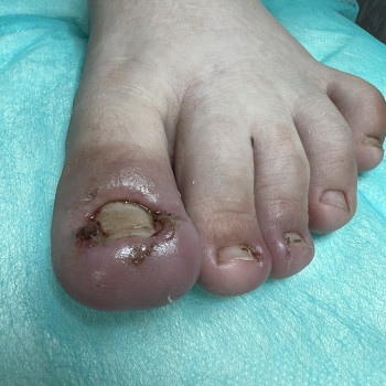 4 ступінь, двостороннє вростання