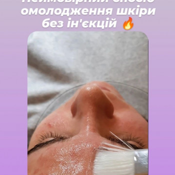 КарбоксіТерапія
                    Салон красоты Імперія краси Кременчуг