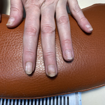 Зачистка нігтів при опіку НП