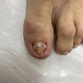 Кліщевидний ніготь. Встановлено титанову нитку