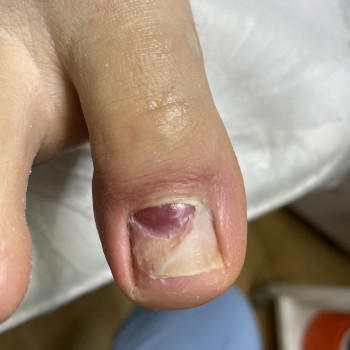 Травма матрекса. Зачистили.