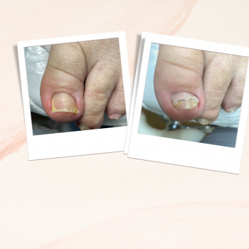 Корекція деформованої нігтьовоі пластини.