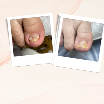 Корекція деформованої нігтьовоі пластини