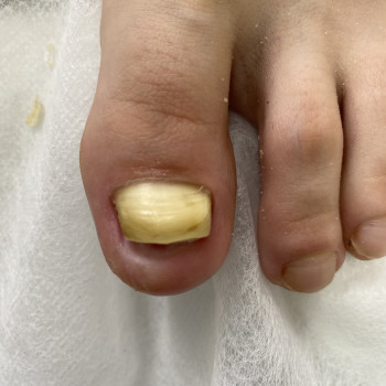 Таж клієнтка під час лікування