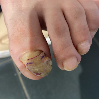 Молода дівчина. Травма нігтя