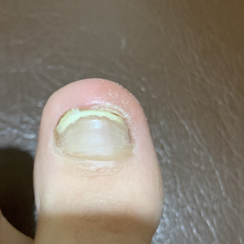 Результат на листопад 2023. Рік лікування