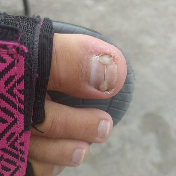 Була встановлена титанова нитка для виправлення росту НП