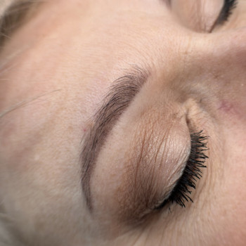 Загоєні після першої процедури