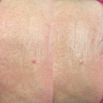 Пілінг МСА - 35
                    Косметолог Людмила Киев