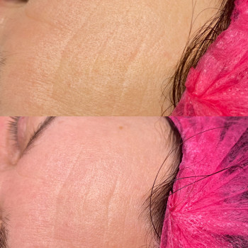 Пілінг МСА - 35
                    Косметолог Людмила Киев