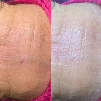 Пілінг МСА - 35
                    Косметолог Людмила Киев