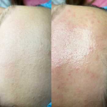 Пілінг МСА - 35
                    Косметолог Людмила Киев