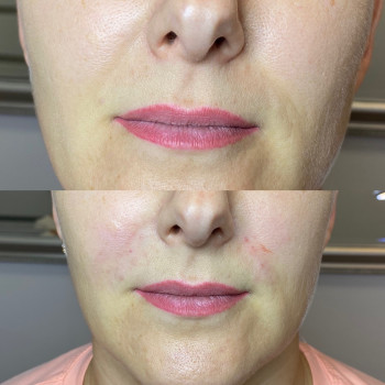 Заповнення носогубних зморшок
                    Косметолог Людмила Киев