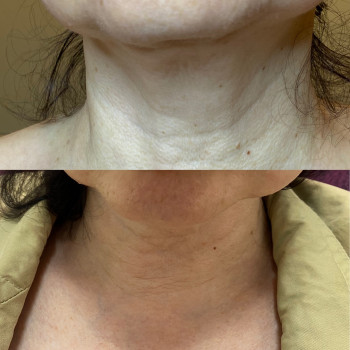 Мезотерапія для ущільнення шкіри
                    Косметолог Людмила Київ