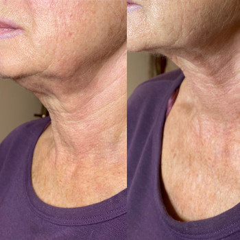 Мезотерапія для ущільнення шкіри
                    Косметолог Людмила Київ