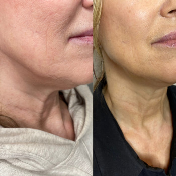 Мезотерапія для ущільнення шкіри
                    Косметолог Людмила Київ