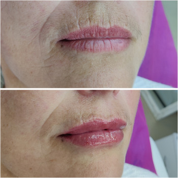 Губы с проработкой кисетных морщин