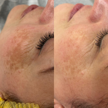 MCA innoaesthetics
                    Косметолог Маргарита Черкассы