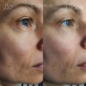 Міоліфтинговий масаж обличчя
                    Масажний салон VIDA Massage Studio Вінниця