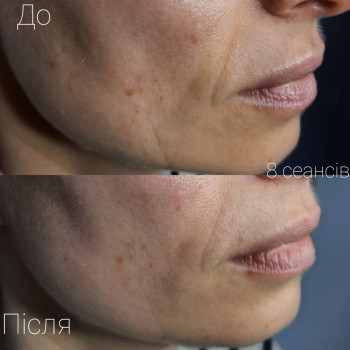 Міоліфтинговий масаж обличчя
                    Масажний салон VIDA Massage Studio Вінниця