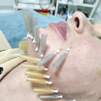 3-Д ліфтинг. Нитьовий ліфтинг.