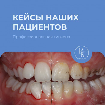 Професійна гігієна