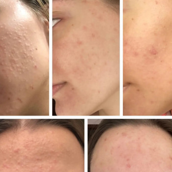 Лікування акне
                    Дерматолог косметолог Виктория Александровна Кривой Рог