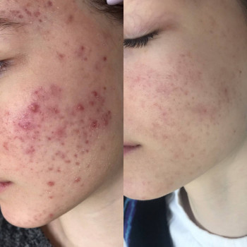 Лікування акне
                    Дерматолог косметолог Виктория Александровна Кривой Рог