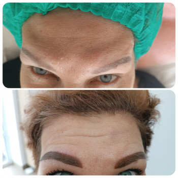 Ботулінотерапія міжбрів'я Botox Allergan
                    Лікар-косметолог Юлія Луцьк